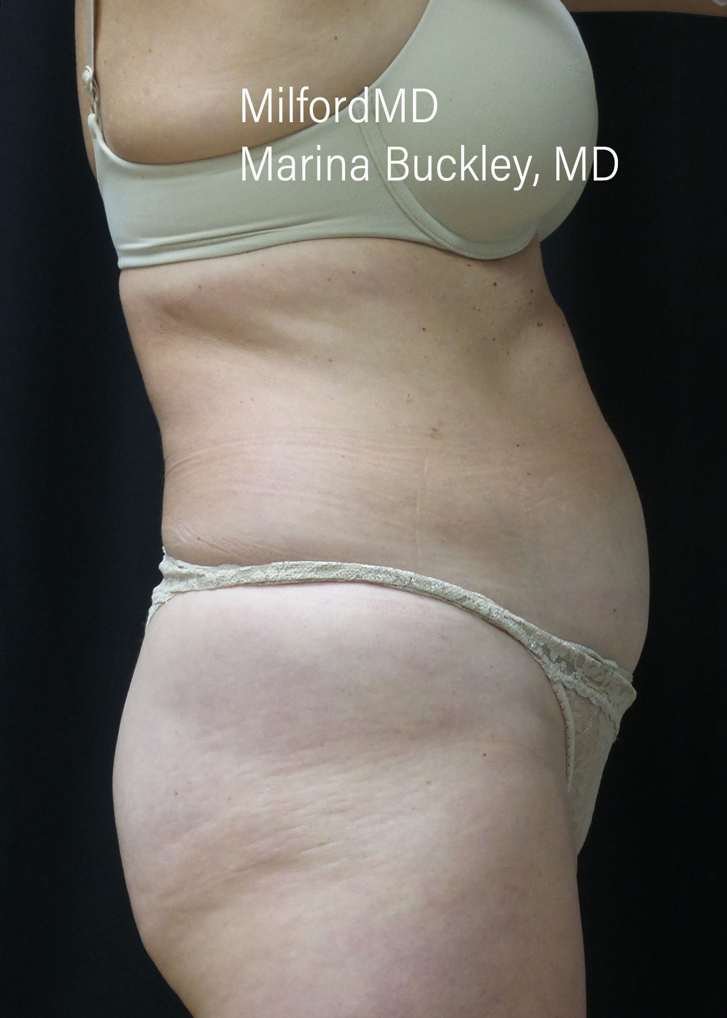 Before: CoolSculpting® Love Handles – Case #36124