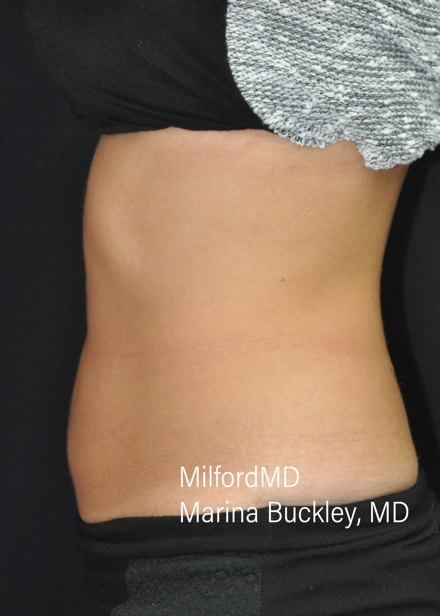 After: CoolSculpting® Body Treatments Using CoolSculpting® Love Handles – Case #36120