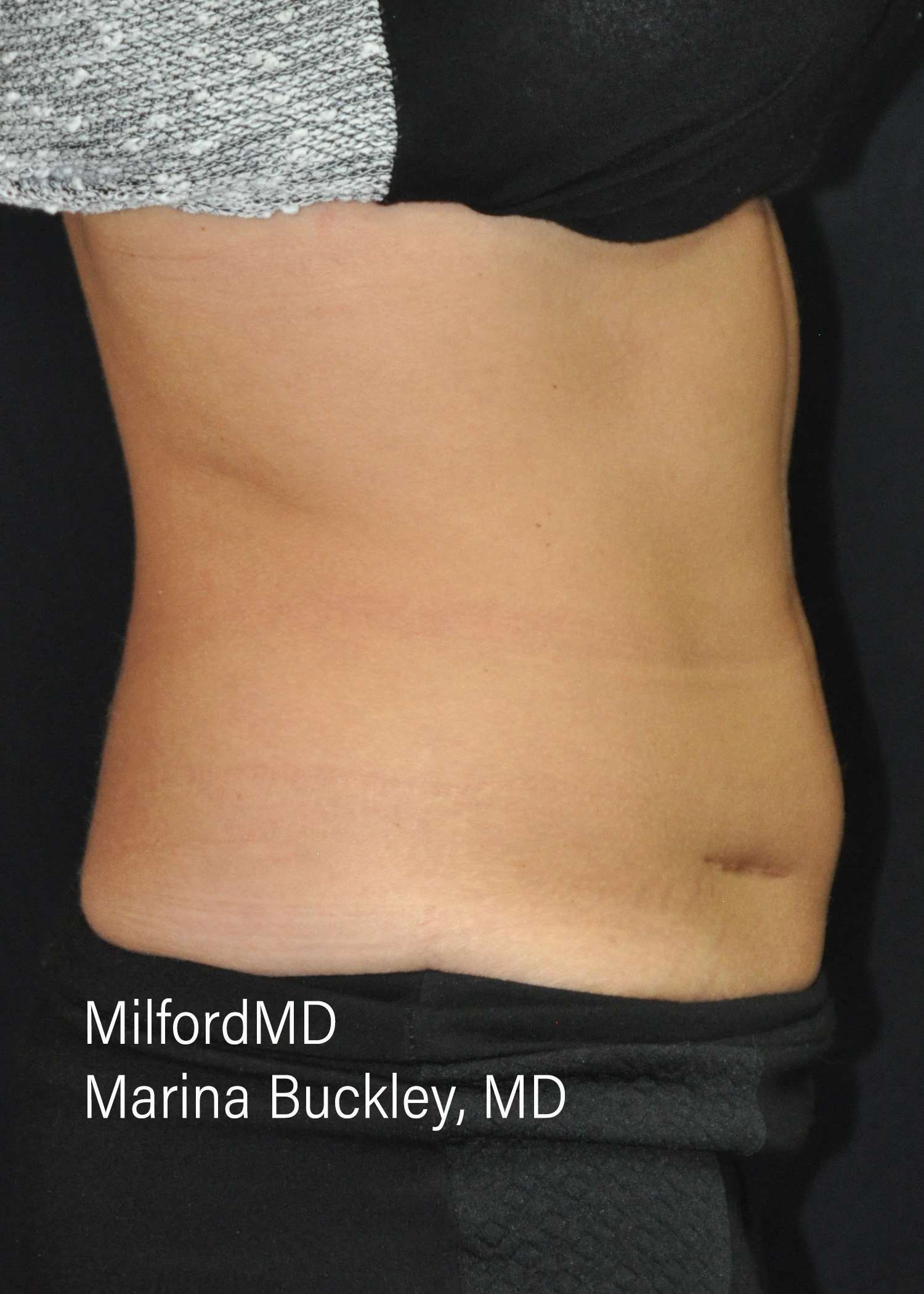 After: CoolSculpting® Body Treatments Using CoolSculpting® Love Handles – Case #36120