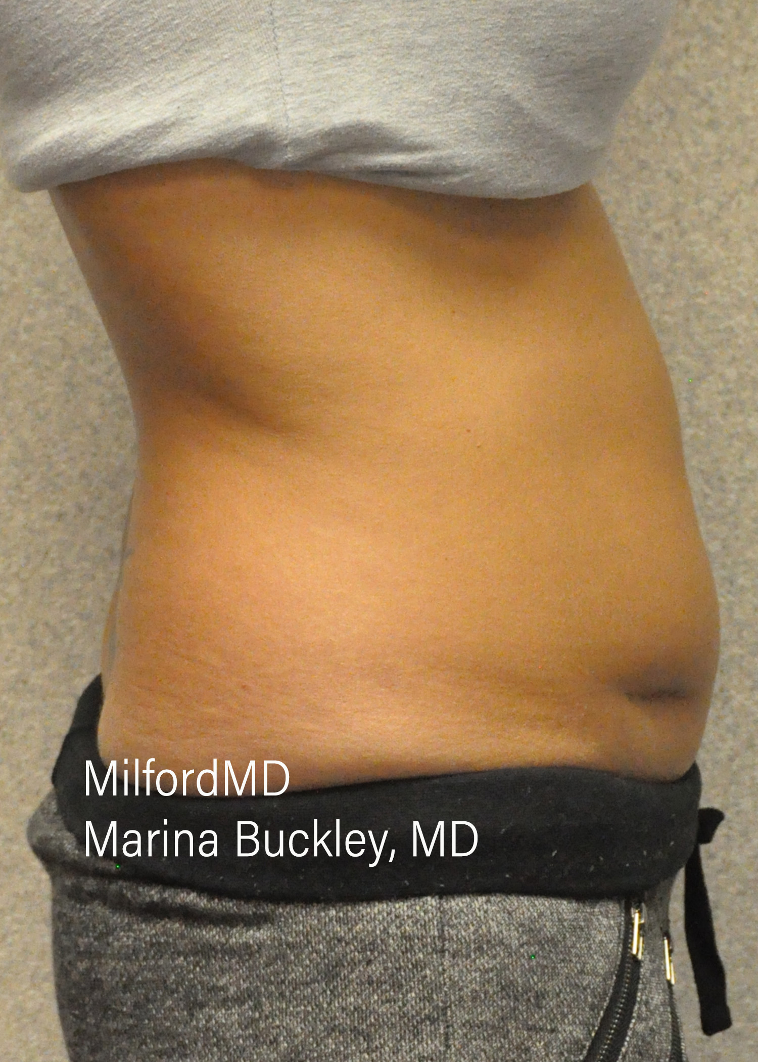 Before: CoolSculpting® Body Treatments Using CoolSculpting® Love Handles – Case #36120