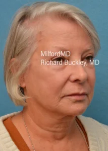 fraxel-procedures-after-by MilfordMD in Richard Buckley, MD