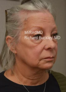 fraxel-procedures-before-by MilfordMD in Richard Buckley, MD