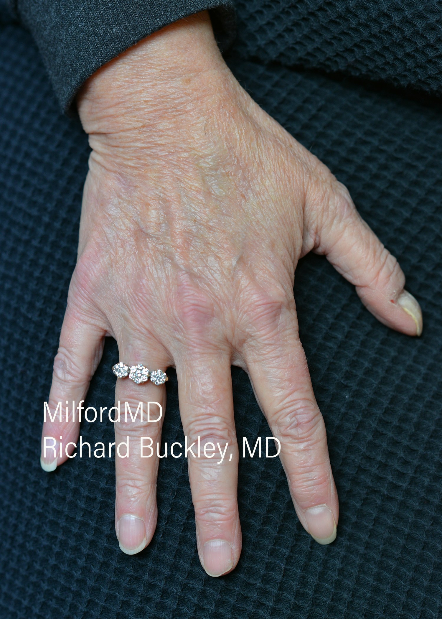Before: Fat Transfer Hands – Case #35923