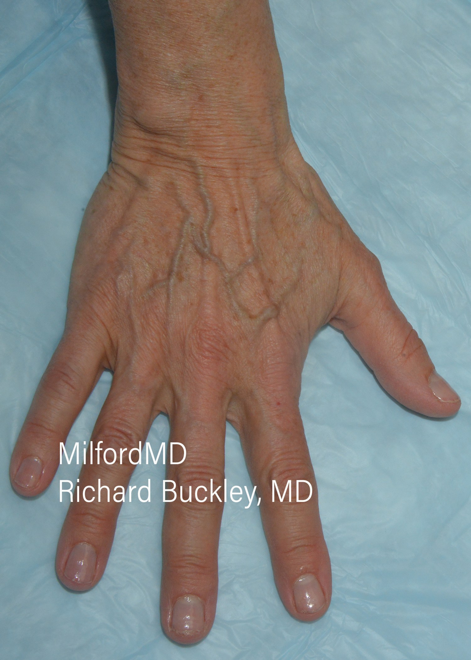 Before: Fat Transfer Hands – Case #35924