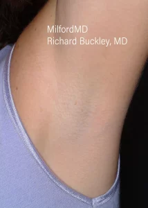 laser-hair-removal-procedures by MilfordMD in Milford, PA