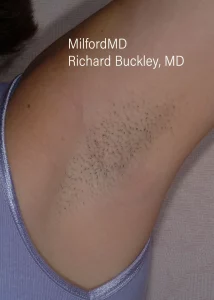 laser-hair-removal-procedures MilfordMD in Milford, PA