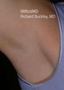 laser-hair-removal-procedures by MilfordMD in Richard E. Buckley, MD