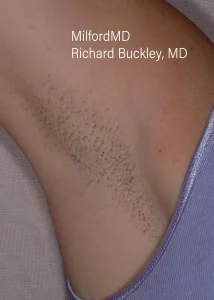 laser-hair-removal-procedures by MilfordMD in Richard E. Buckley, MD