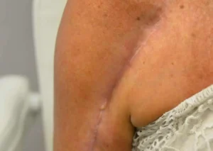 scar-revision-one-featured-Before-Milford-PA-MilfordMD