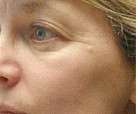 rejuvenation phototherapy before by MilfordMD