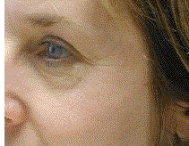 rejuvenation omnilux by MilfordMD