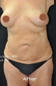 Breast-Aug-Tummy-Tuck-Lio-after-by MilfordMD