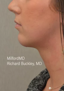 chin injections by MilfordMD