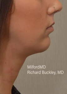 Chin-Augmentation by MilfordMD in Richard Buckley, MD