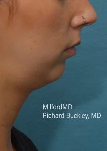 chin implant by MilfordMD