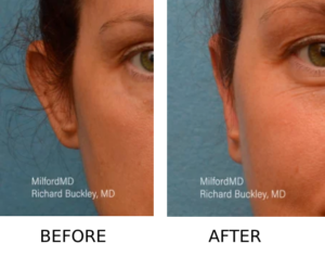 , Transform Your Appearance With Ear Pinning Otoplasty