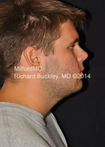 non invasive double chin removal by MilfordMD in Richard Buckley, MD