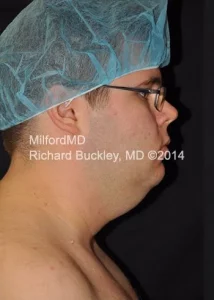 fat freezing double chin by MilfordMD in Richard Buckley, MD