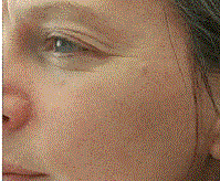 rejuvenation phototherapy by MilfordMD in Milford, PA