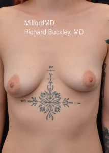 Breast Augmentation Ten Front Before Milford PA MilfordMD