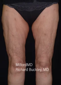 Leg Vein Treatments Two Front After Milford PA MilfordMD