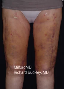 Leg Vein Treatments Two Front Before Milford PA MilfordMD