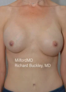 Breast-Implant-Revision-Two-Front-After-Milford-PA-MilfordMD