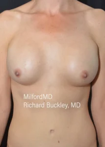 Breast-Implant-Revision-Two-Front-Before-Milford-PA-MilfordMD