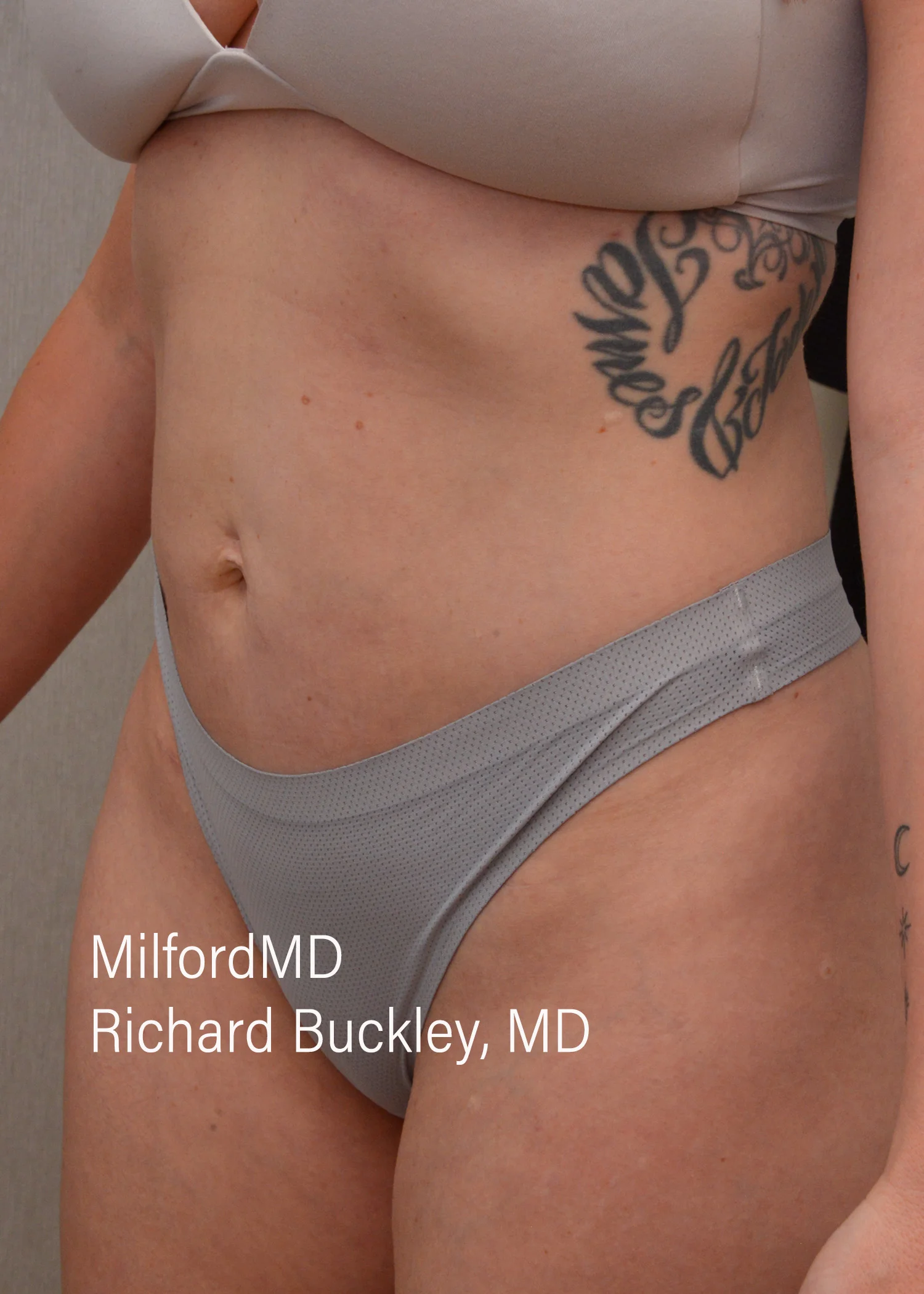 After: HD BODY SCULPTING PROCEDURES – CASE #62205