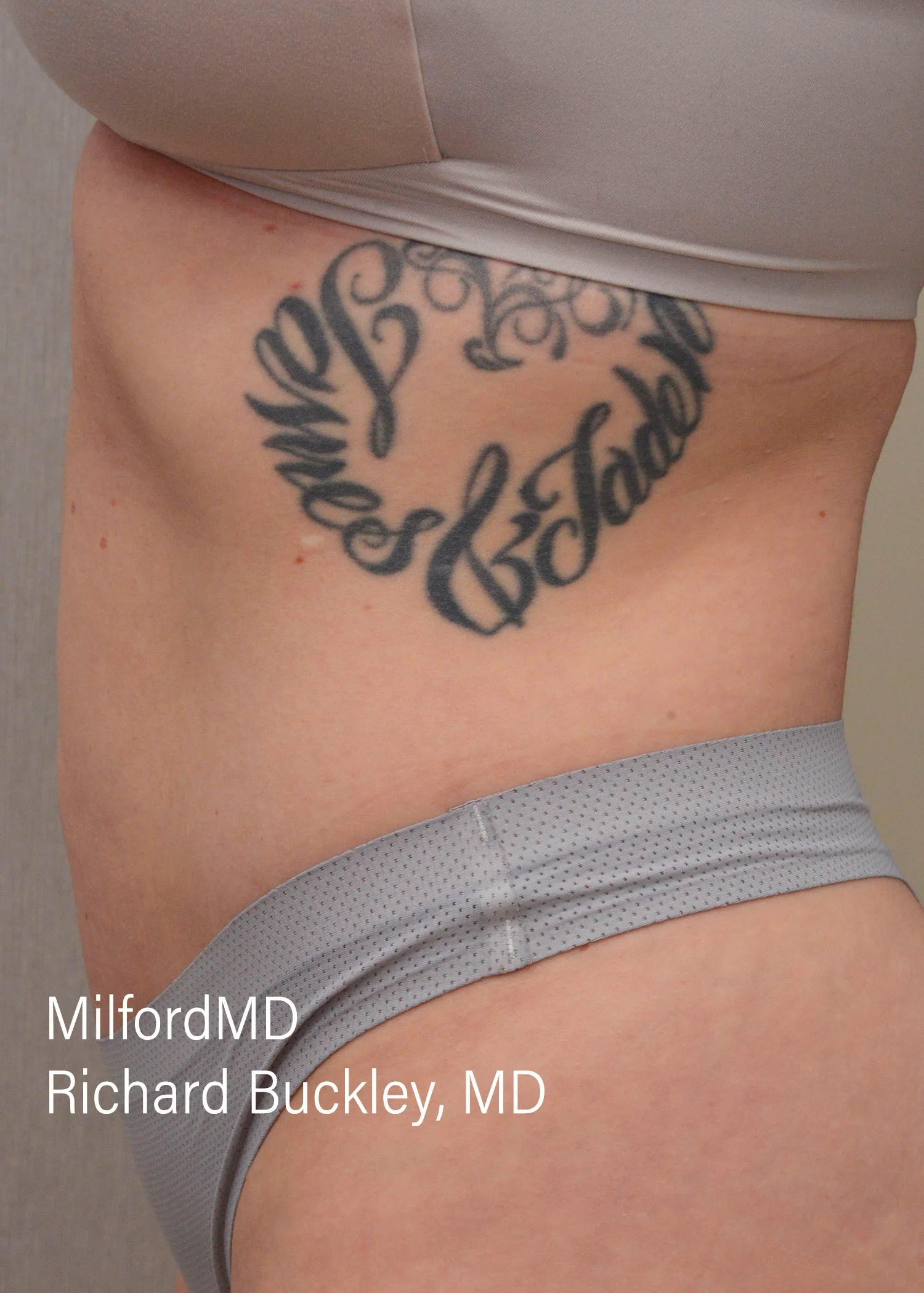 After: HD BODY SCULPTING PROCEDURES – CASE #62205