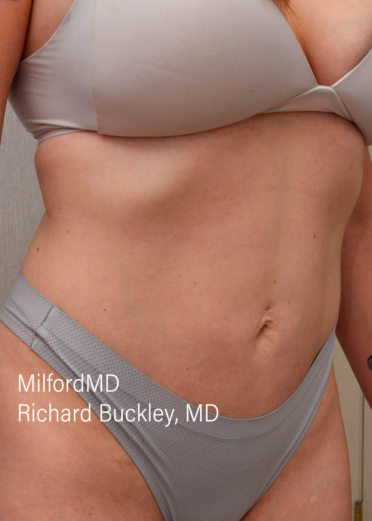 After: HD BODY SCULPTING PROCEDURES – CASE #62205