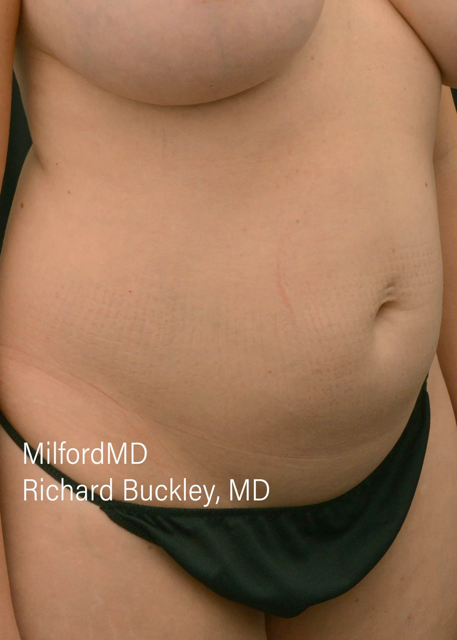 Before: HD BODY SCULPTING PROCEDURES – CASE #62205