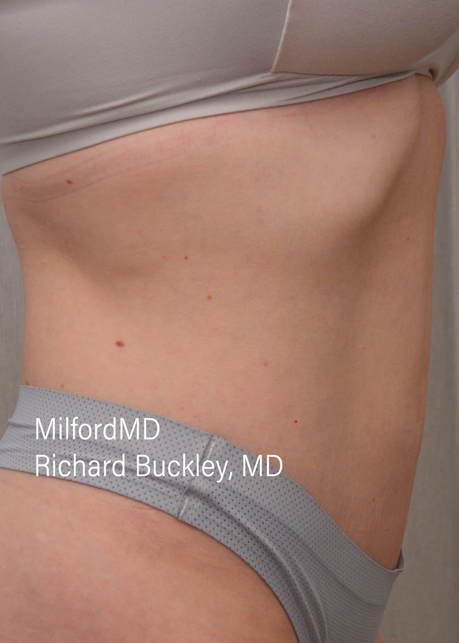 After: HD BODY SCULPTING PROCEDURES – CASE #62205