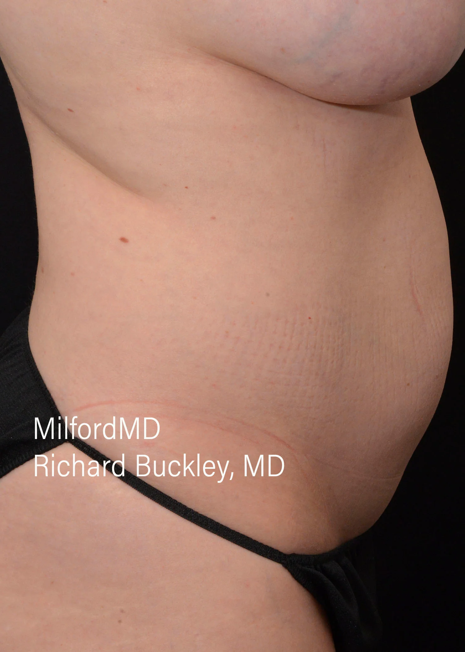 Before: HD BODY SCULPTING PROCEDURES – CASE #62205