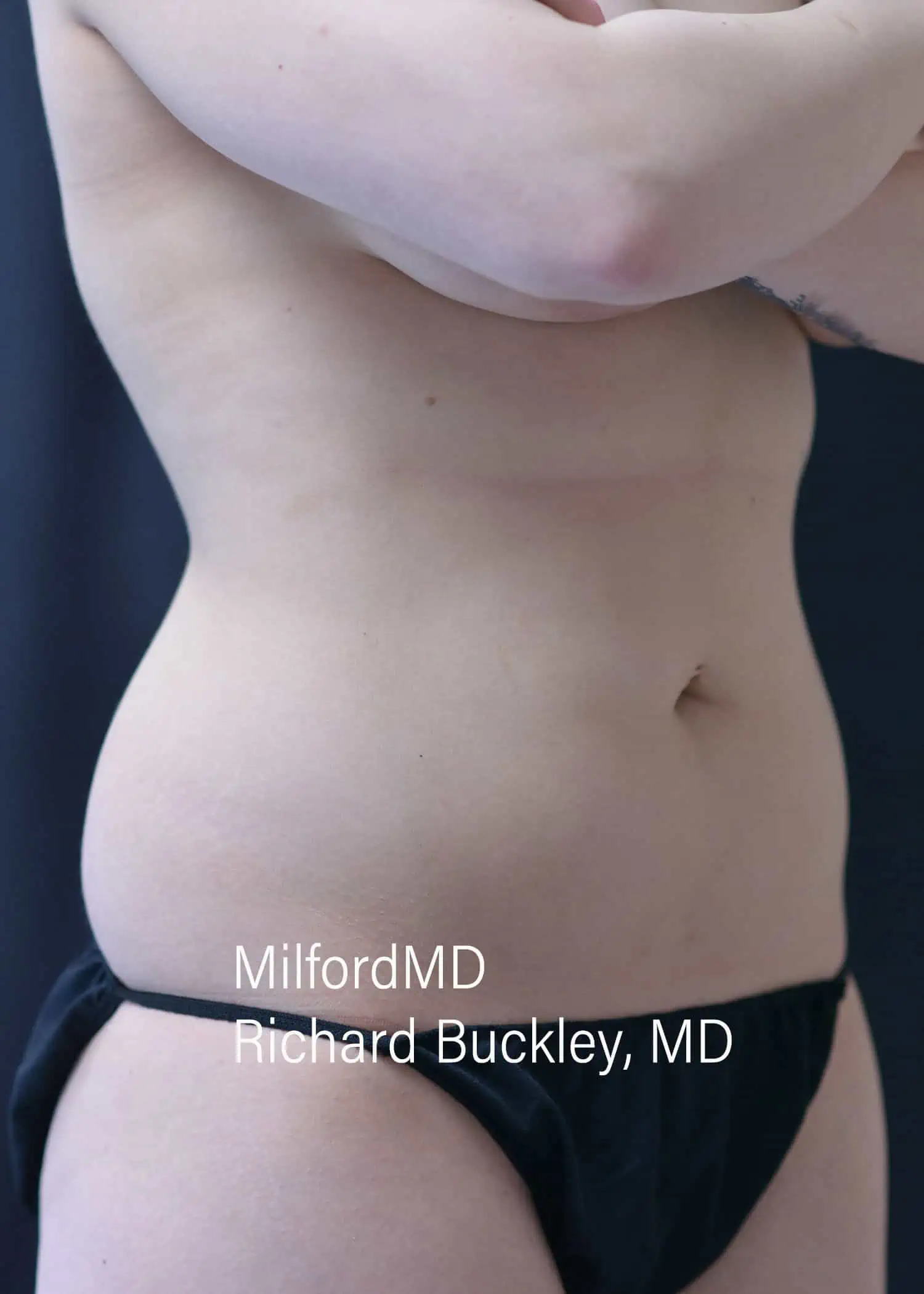 Before: HD BODY SCULPTING PROCEDURES – CASE #62204