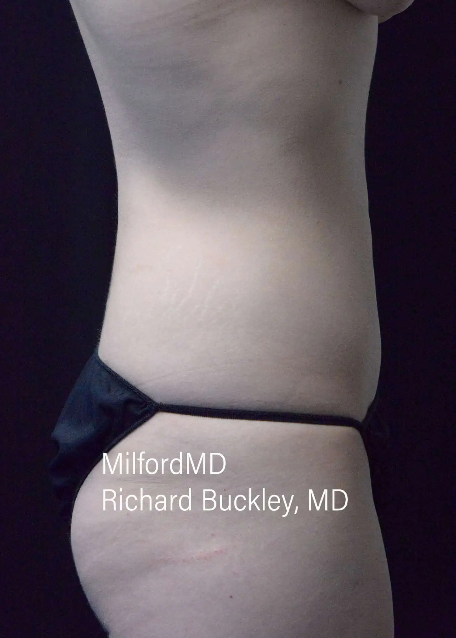 After: HD BODY SCULPTING PROCEDURES – CASE #62204