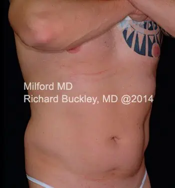 Before: HD BODY SCULPTING PROCEDURES – CASE #62201