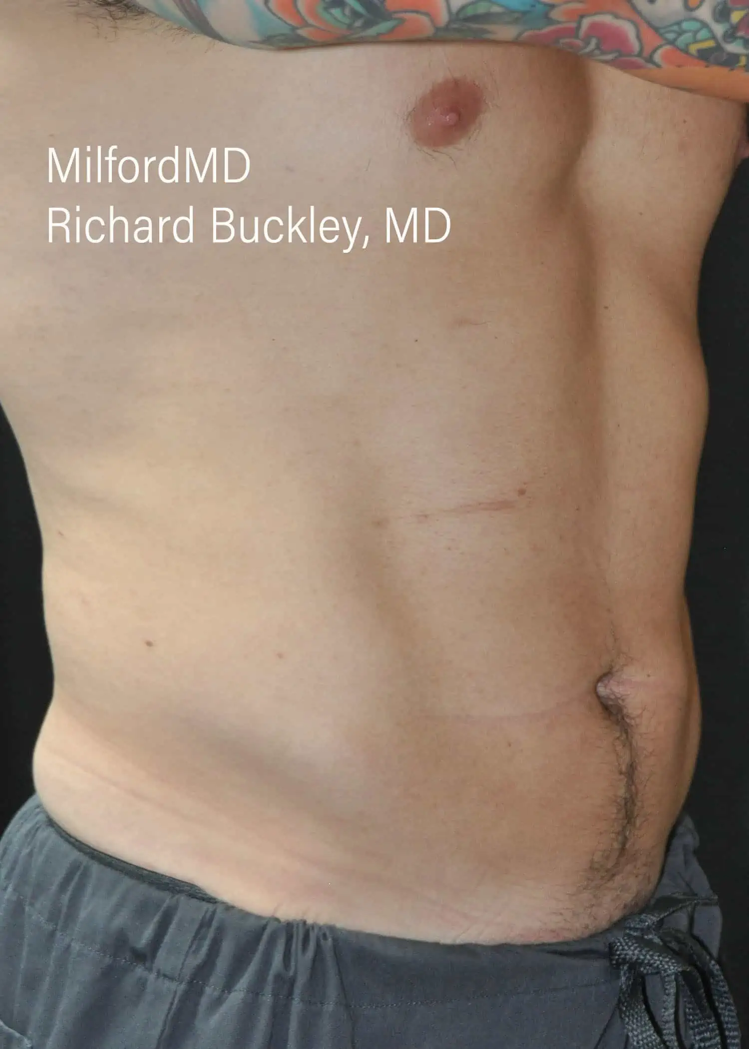 Before: HD BODY SCULPTING PROCEDURES – CASE #62203