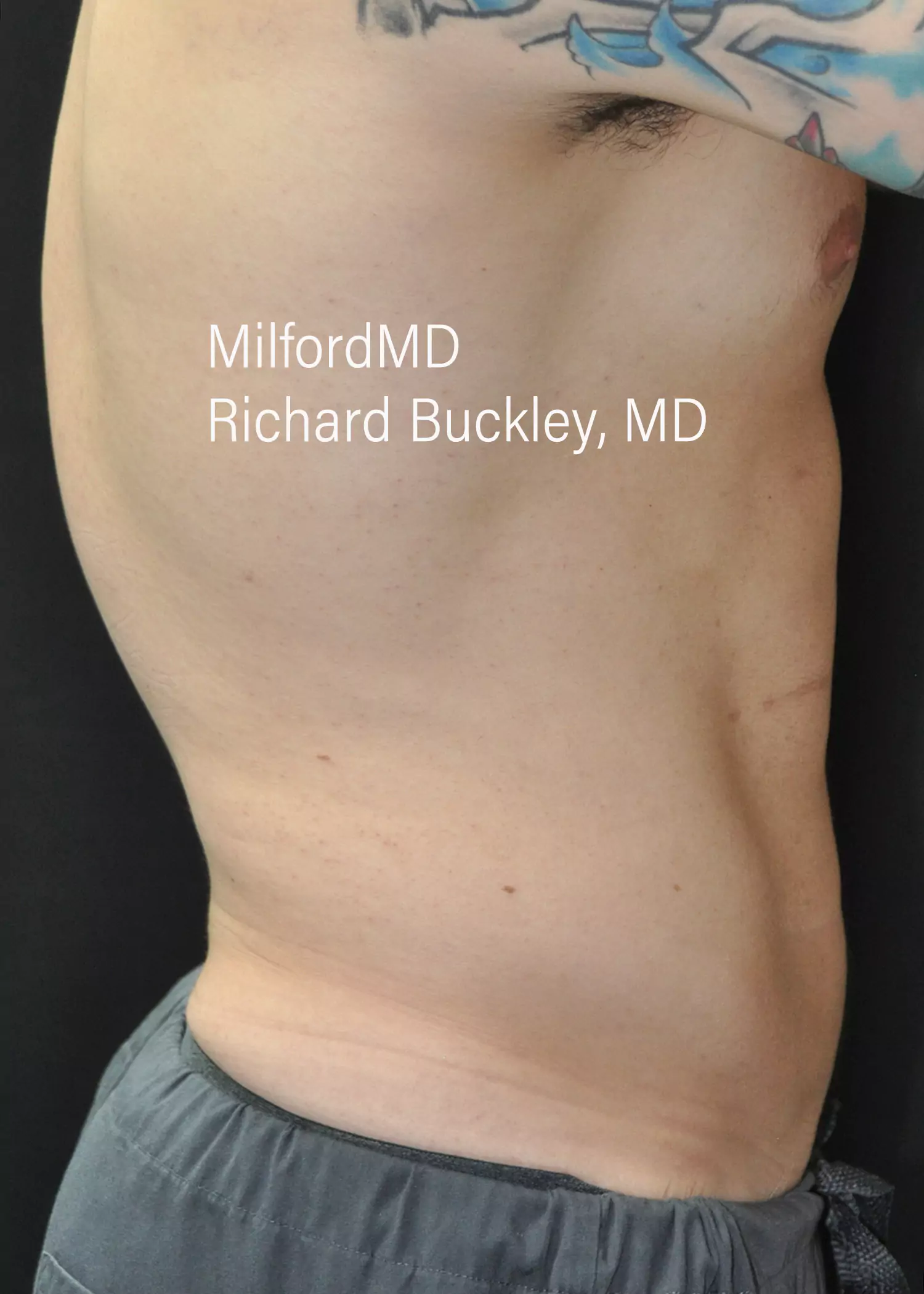 Before: HD BODY SCULPTING PROCEDURES – CASE #62203