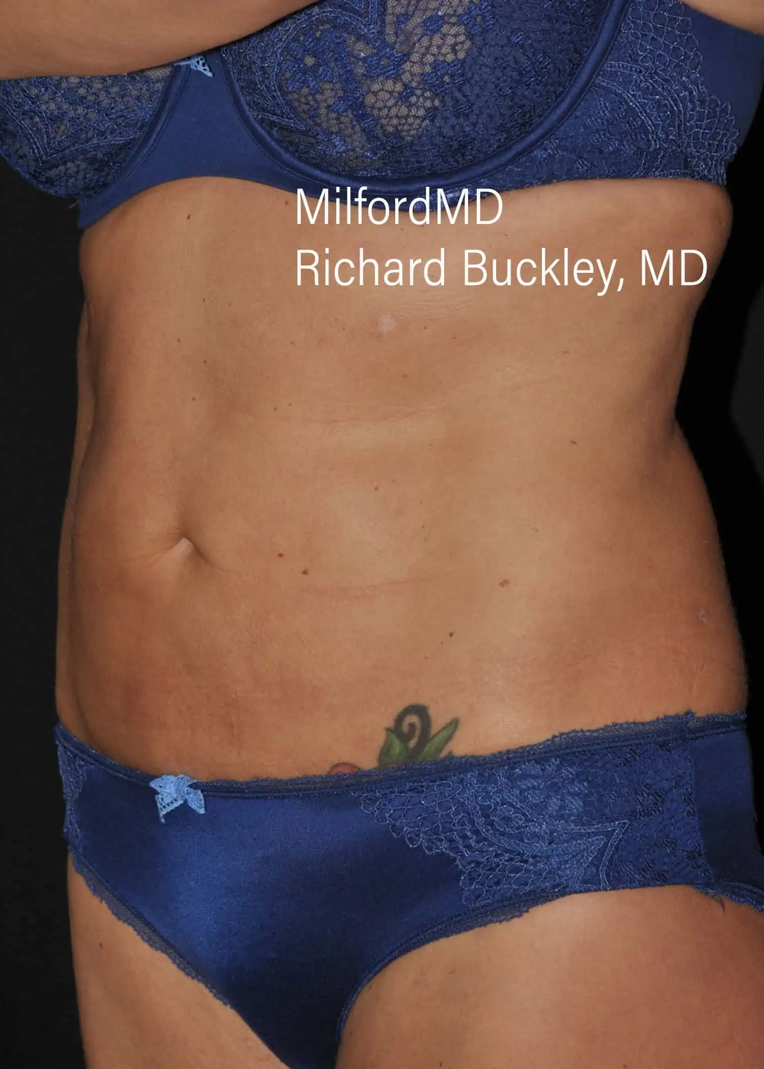 After: HD BODY SCULPTING PROCEDURES – CASE #62202