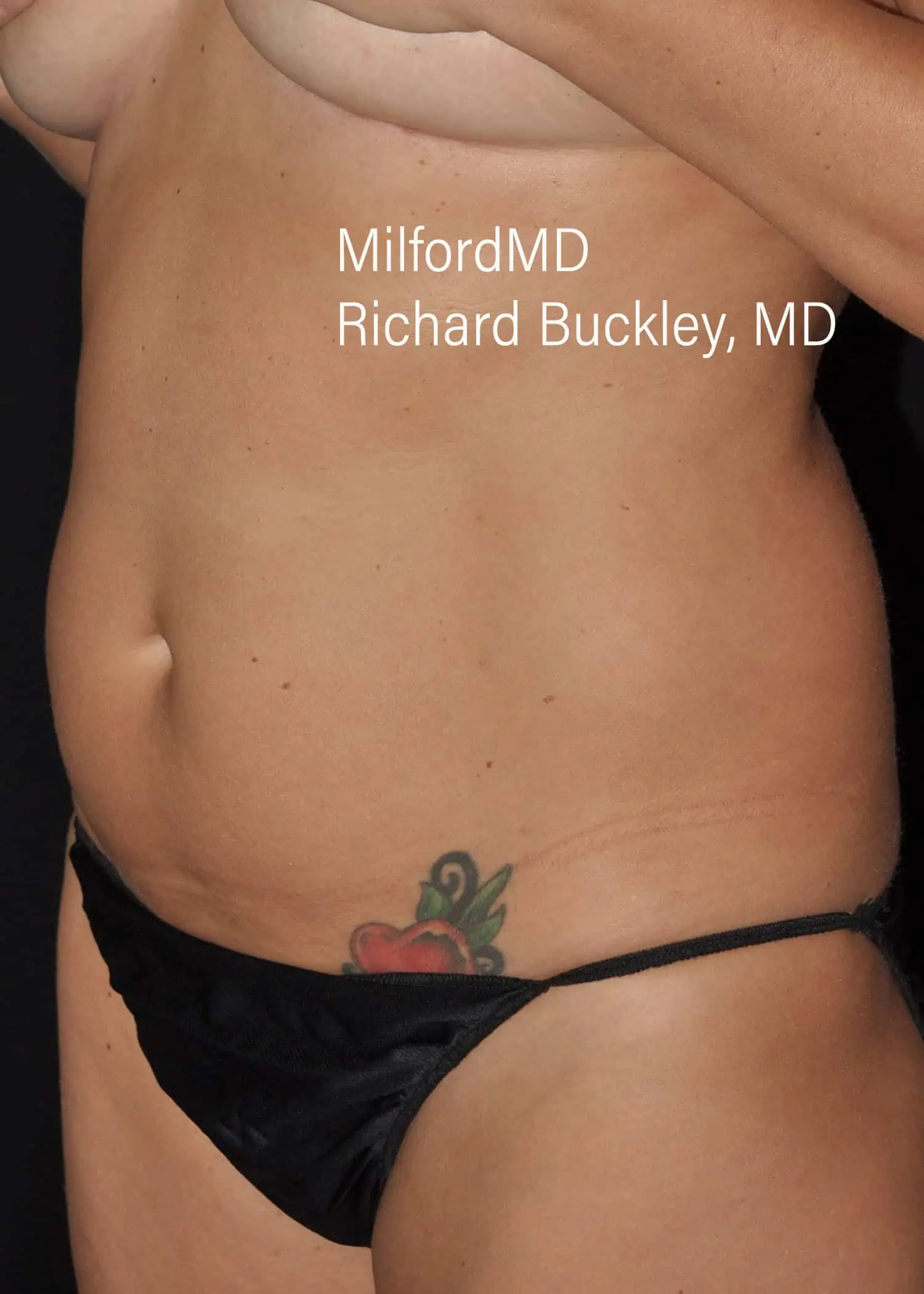 Before: HD BODY SCULPTING PROCEDURES – CASE #62202