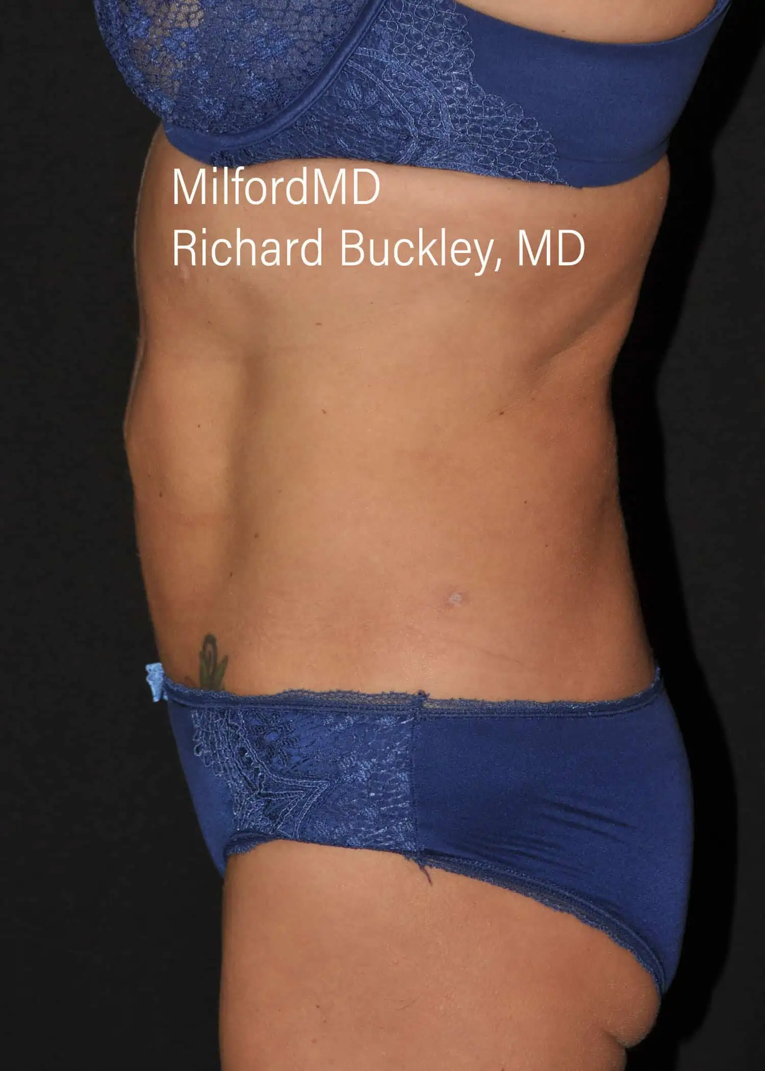 After: HD BODY SCULPTING PROCEDURES – CASE #62202