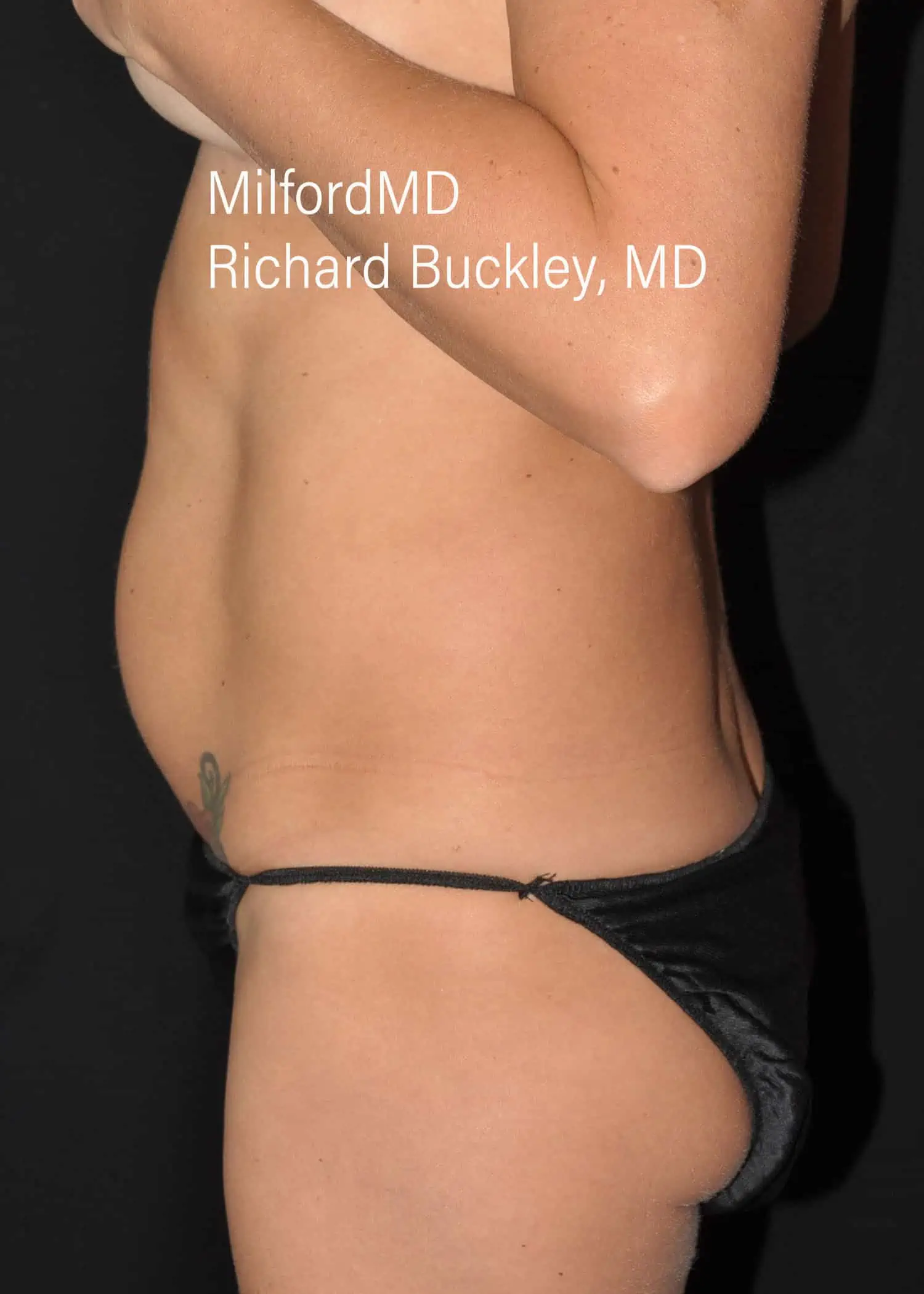 Before: HD BODY SCULPTING PROCEDURES – CASE #62202