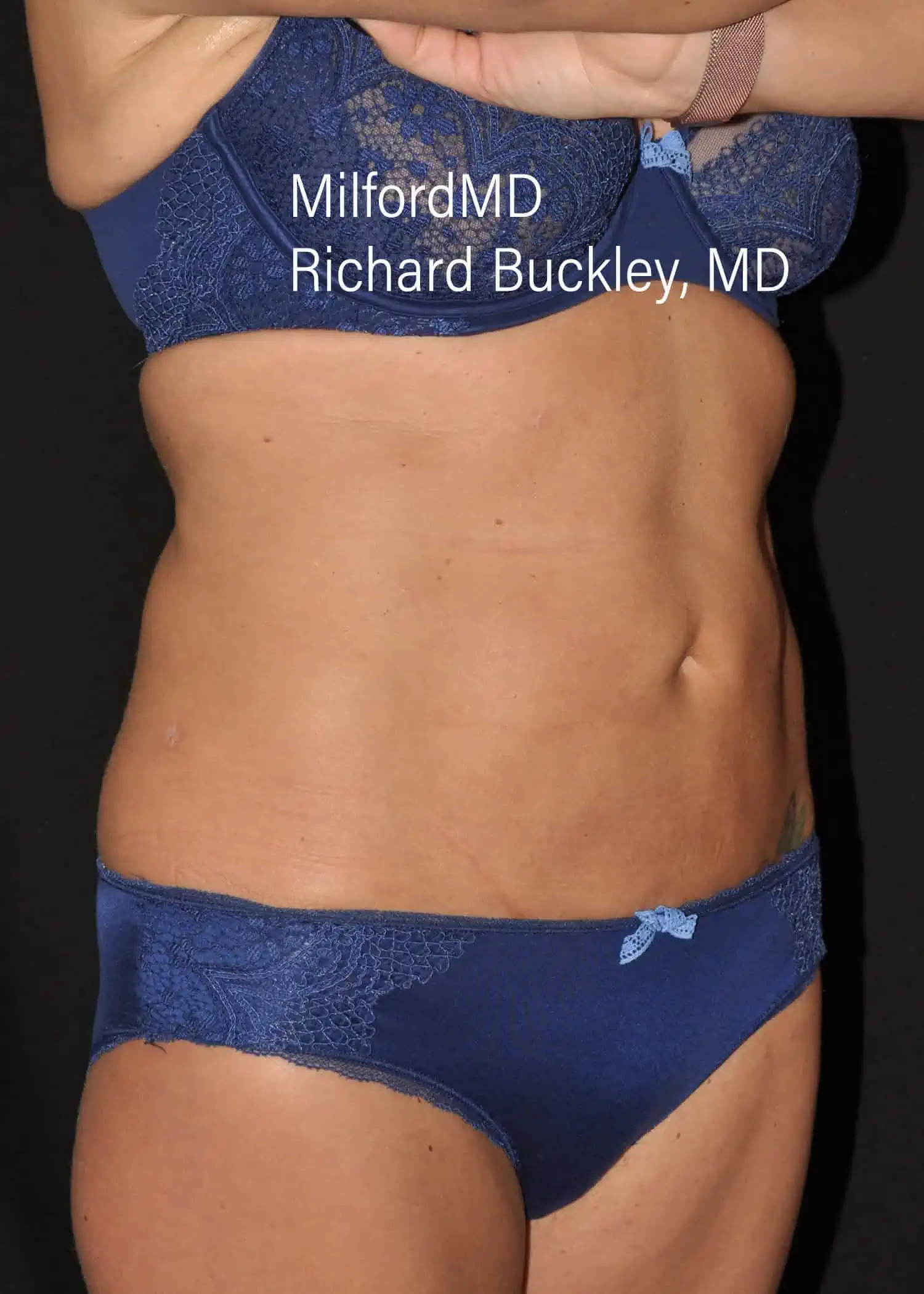 After: HD BODY SCULPTING PROCEDURES – CASE #62202