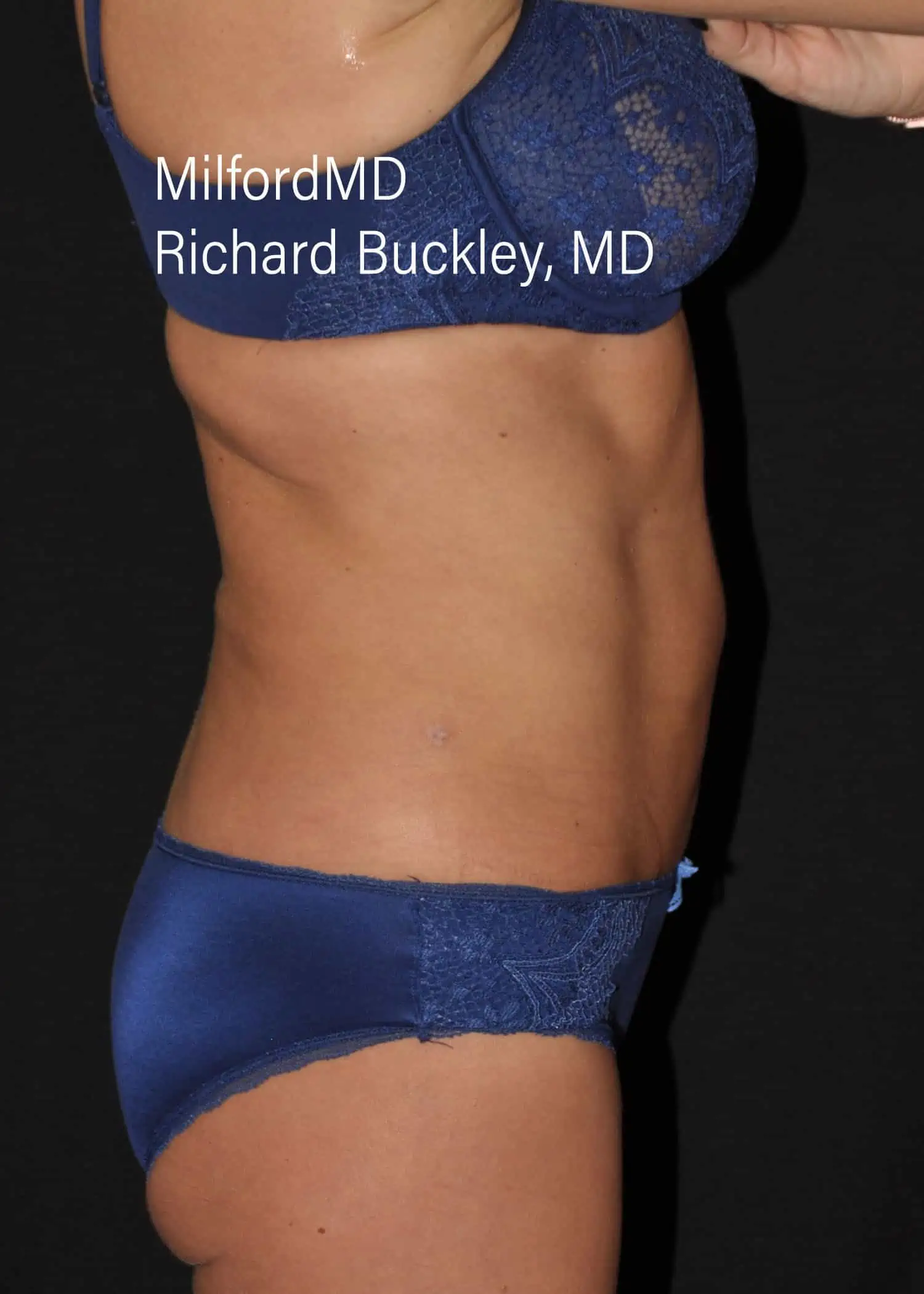 After: HD BODY SCULPTING PROCEDURES – CASE #62202