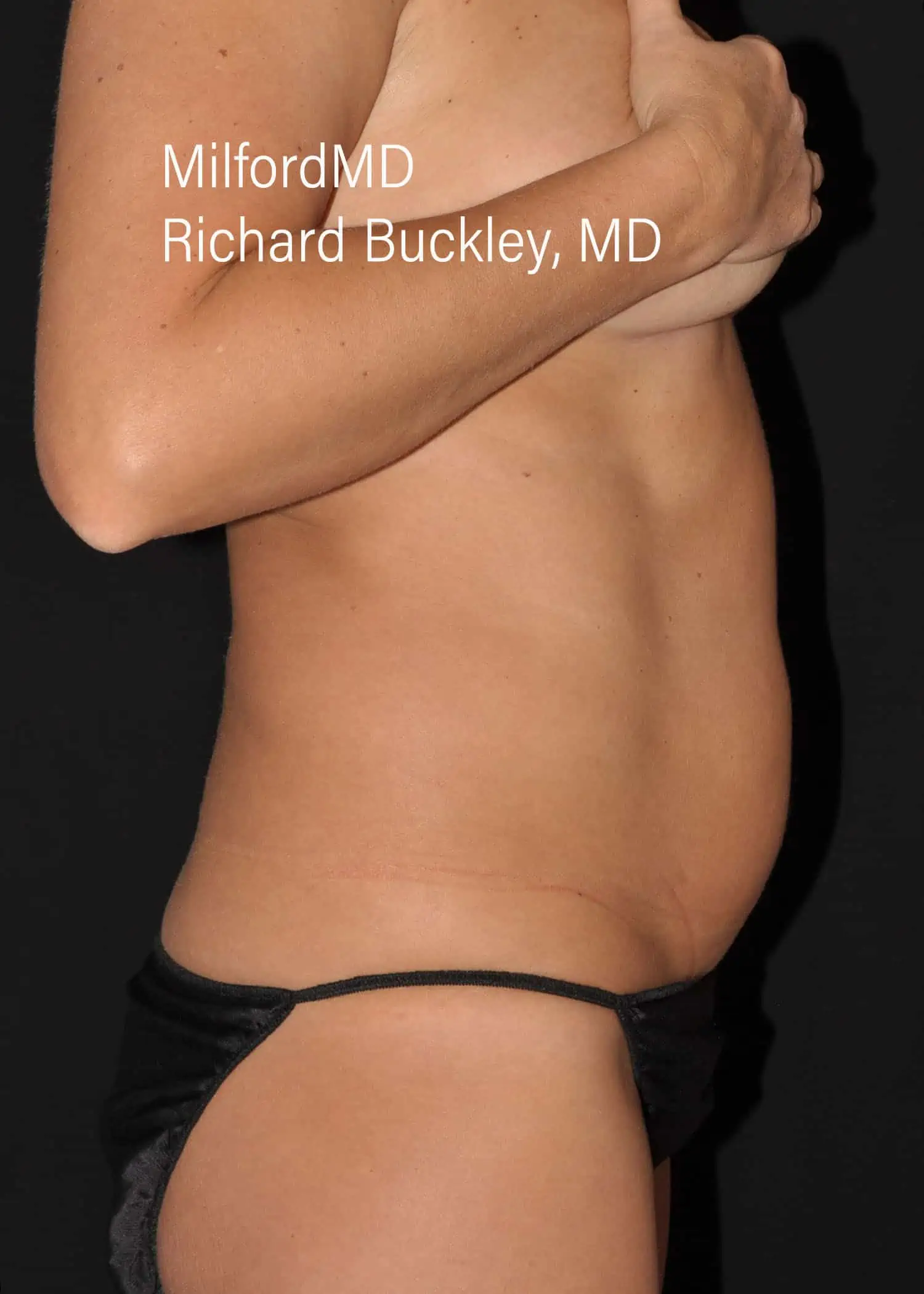 Before: HD BODY SCULPTING PROCEDURES – CASE #62202