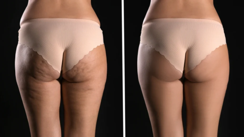 Cellulite Treatments results - before and after