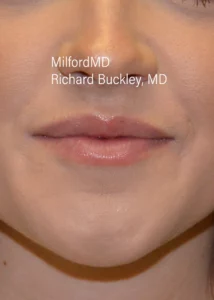 Lip-Augmentation-Six-Front-After-Milford-PA-MilfordMD.webp