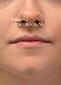 Lip-Augmentation-Six-Front-Before-Milford-PA-MilfordMD.webp