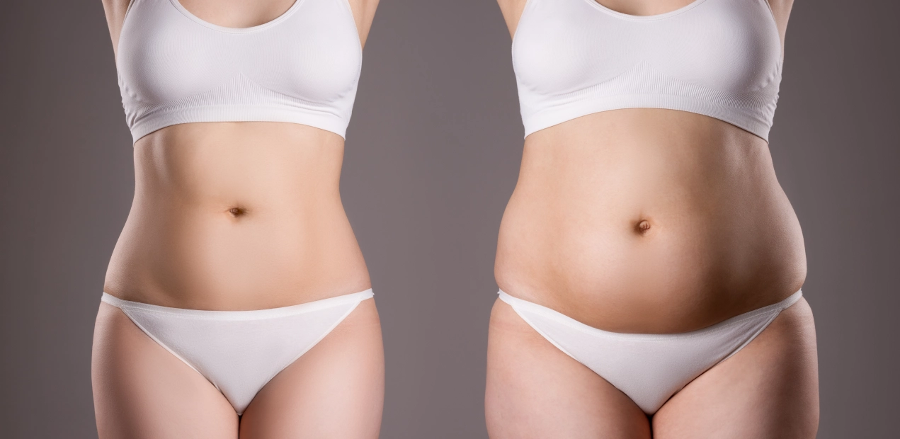 Fat and Loose Skin Removal, Milford Fat Loose Skin Removal